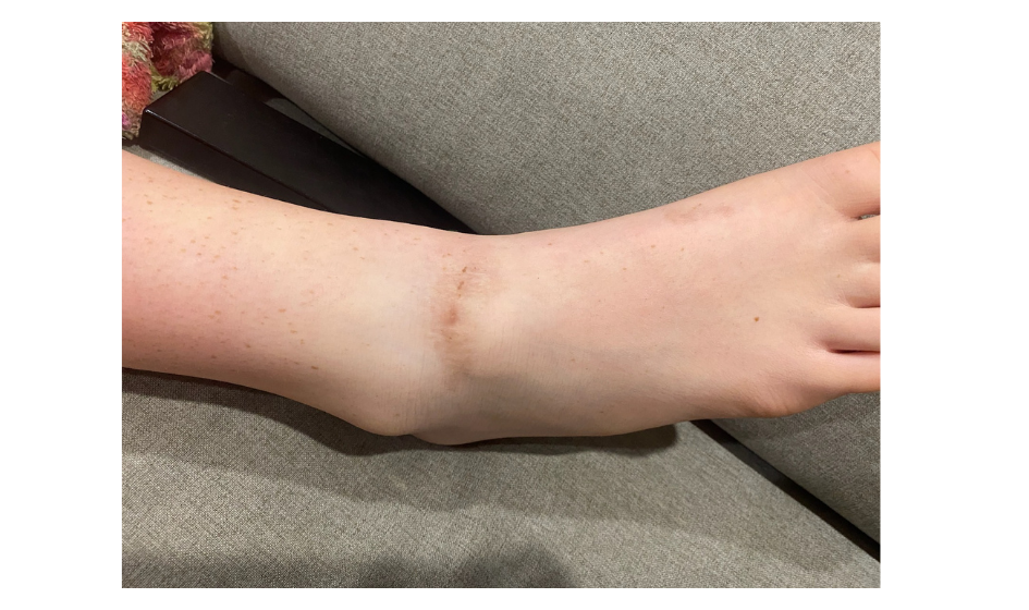 Image for Examples of deep partial thickness burns.