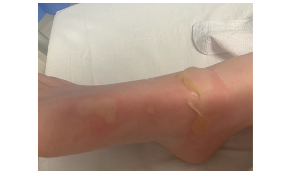 Image for Examples of deep partial thickness burns.